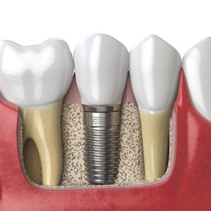 illustration depicting how dental implants work in Lebanon
