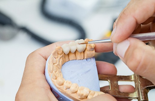 a dentist crafting a customized dental crown in Lebanon
