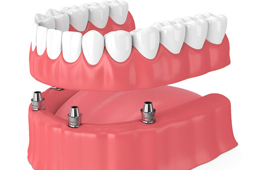 3D render of implant dentures