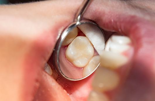 Picture of a filled tooth