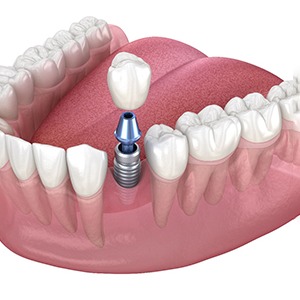 A dental implant in Lebanon