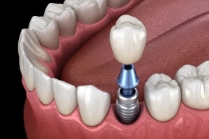 Animated implant supported dental crown placement