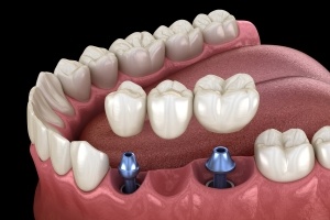 Animated implant supported fixed bridge placement