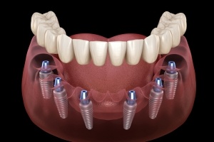 Animated implant supported denture placement