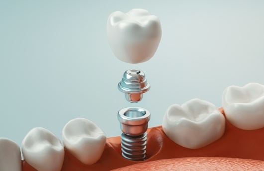 Animated implant supported tooth replacement components