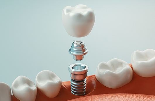 Animated dental implant placement