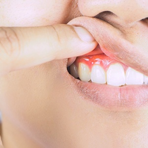 Woman with gum disease