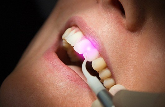 Patient receiving soft tissue laser dentistry treatment