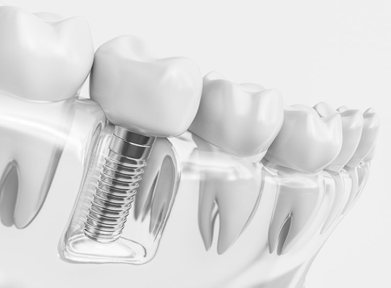 model of a dental implant