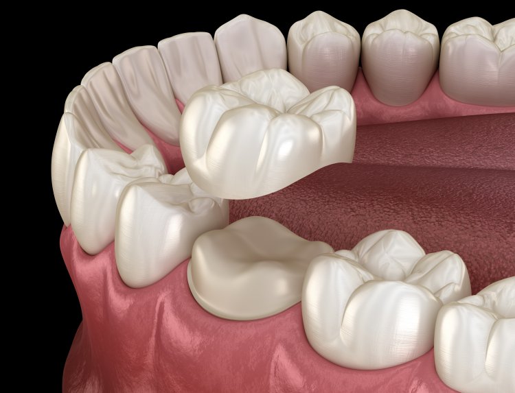 A 3D illustration of dental crown placement