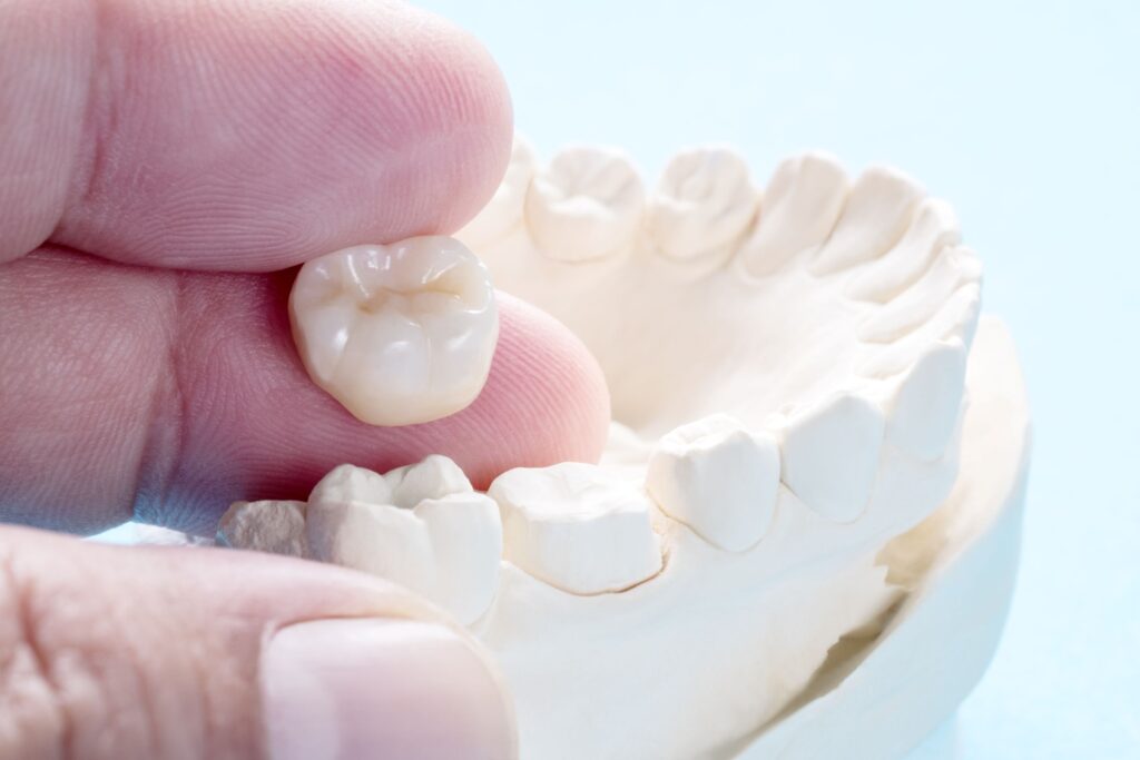 Fingers holding tooth-colored dental crown and touching cast of lower arch